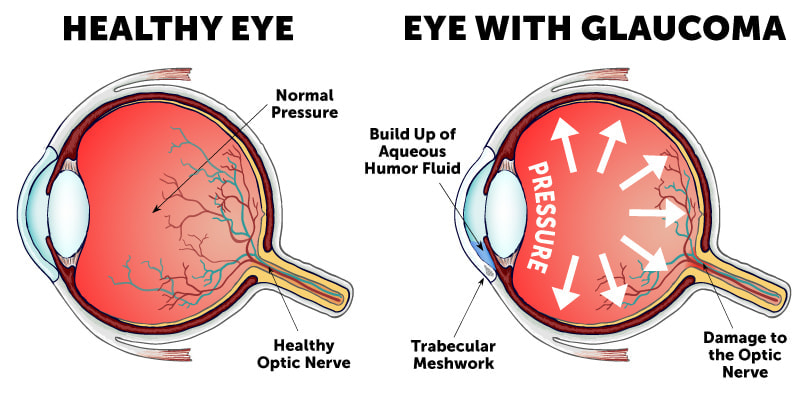 More Than 60M Nigerians at Risk of Glaucoma – Dr. Obinna Awiaka